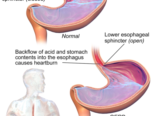How to beat GERD in its tracks!